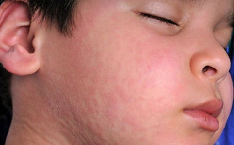 Αλλεργικά εξανθήματα - ένα σύμπτωμα της παρουσίας στο σώμα παρασιτικών σκουληκιών
